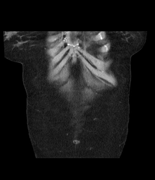 File:Adrenal cortical carcinoma with IVC invasion and thrombosis (Radiopaedia 34307-35597 Coronal C+ portal venous phase 9).jpg