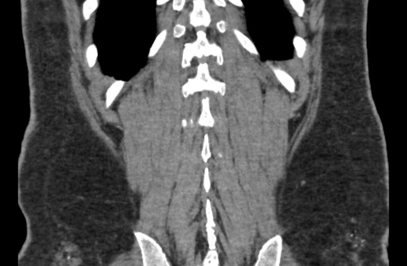 File:Adrenal myelolipoma (Radiopaedia 65240-74253 Coronal non-contrast 67).jpg