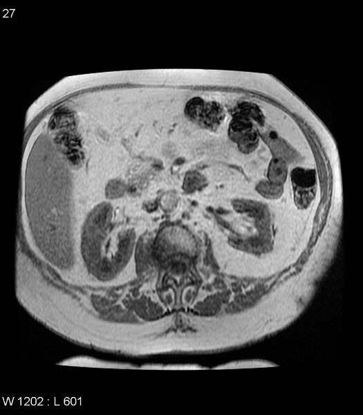 File:Adrenal myelolipoma (Radiopaedia 6765-7961 Axial T1 in-phase 27).jpg