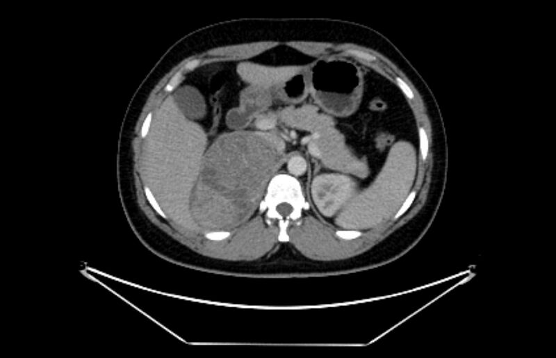 File:Adrenocortical carcinoma (Radiopaedia 80134-93438 Axial C+ portal venous phase 38).jpg