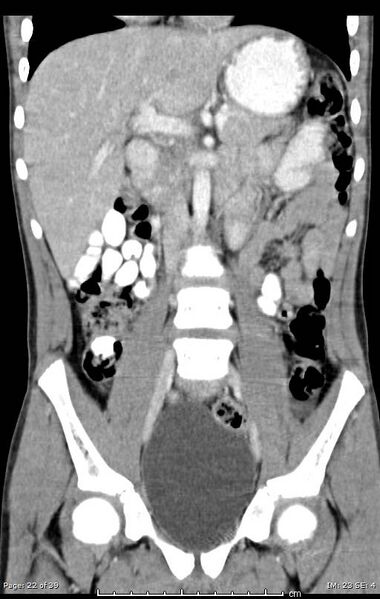 File:Agenesis of the gallbladder (Radiopaedia 55454-61905 A 22).jpg