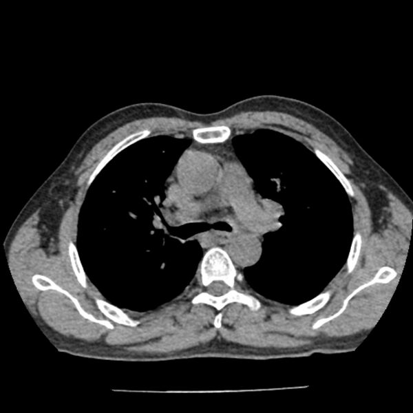 File:Airway foreign body in adult (Radiopaedia 85907-101779 Axial liver window 59).jpg