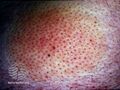 Alopecia mucinosa (DermNet NZ hair-nails-sweat-alop-mucin3).jpg