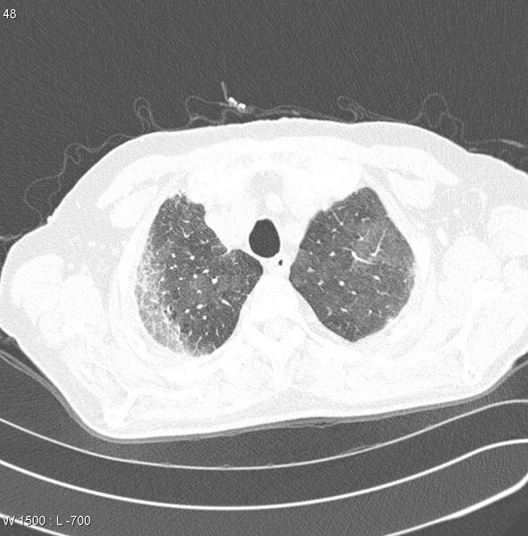 File:Amiodarone lung (Radiopaedia 6539-7851 Axial lung window 4).jpg