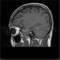 Amnestic syndrome secondary to hypoxic brain injury (Radiopaedia 24743-25004 T1 14).jpg