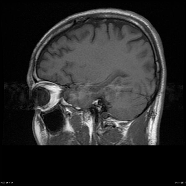 File:Amnestic syndrome secondary to hypoxic brain injury (Radiopaedia 24743-25004 T1 14).jpg