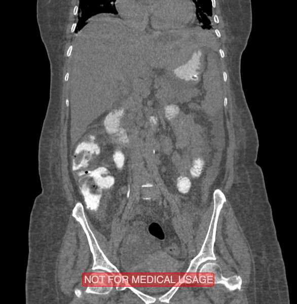 File:Amoebic enterocolitis with liver abscess (Radiopaedia 35100-36609 B 95).jpg