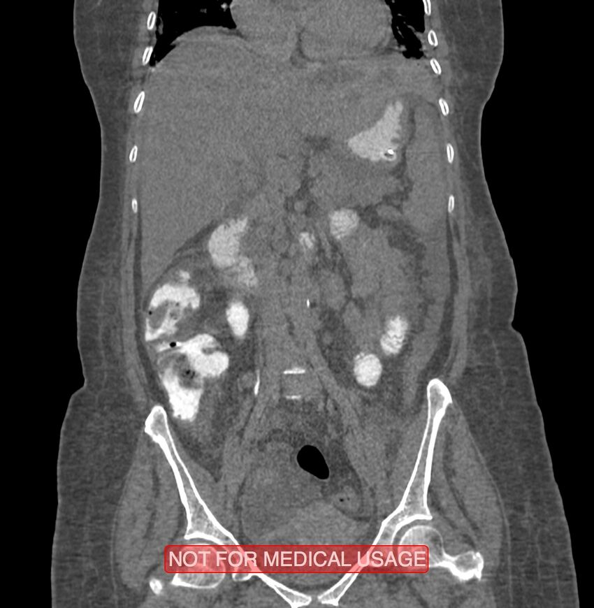 Amoebic enterocolitis with liver abscess (Radiopaedia 35100-36609 B 95).jpg