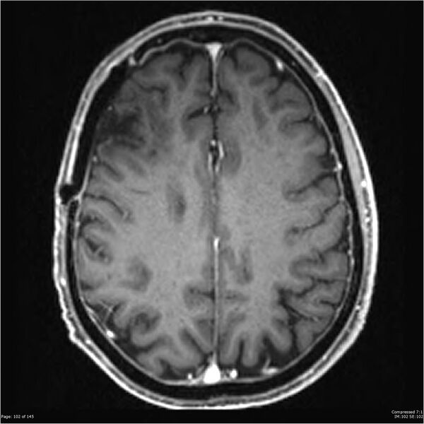 File:Anaplastic meningioma with recurrence (Radiopaedia 34452-35788 Axial T1 C+ 102).jpg