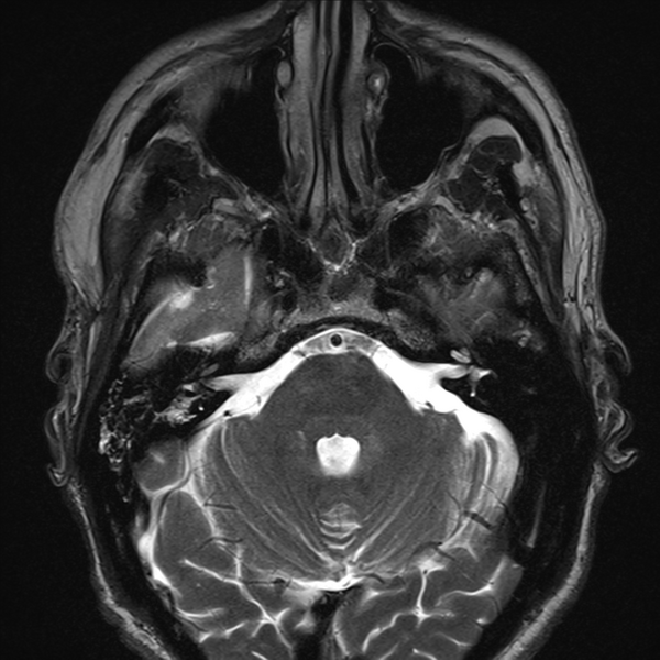 File:Anaplastic meningioma with recurrence (Radiopaedia 34452-35788 Axial T2 2).png