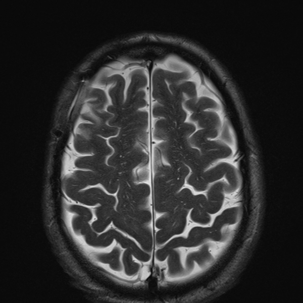 File:Anaplastic meningioma with recurrence (Radiopaedia 34452-35788 Axial T2 23).png