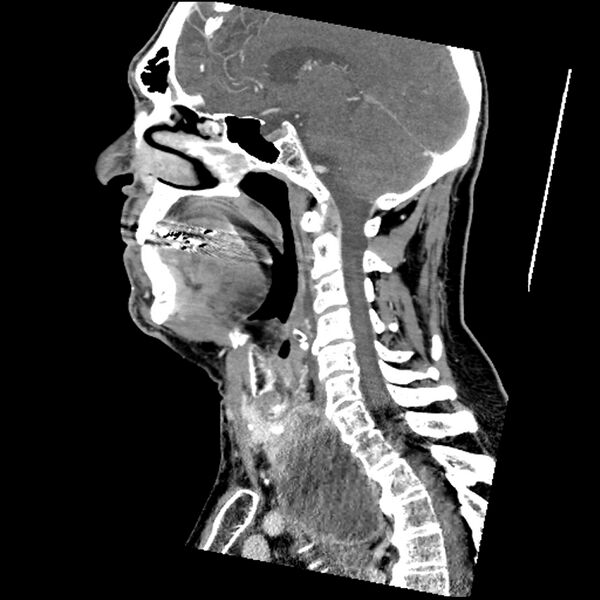 File:Anaplastic thyroid carcinoma (Radiopaedia 79087-92034 C 48).jpg