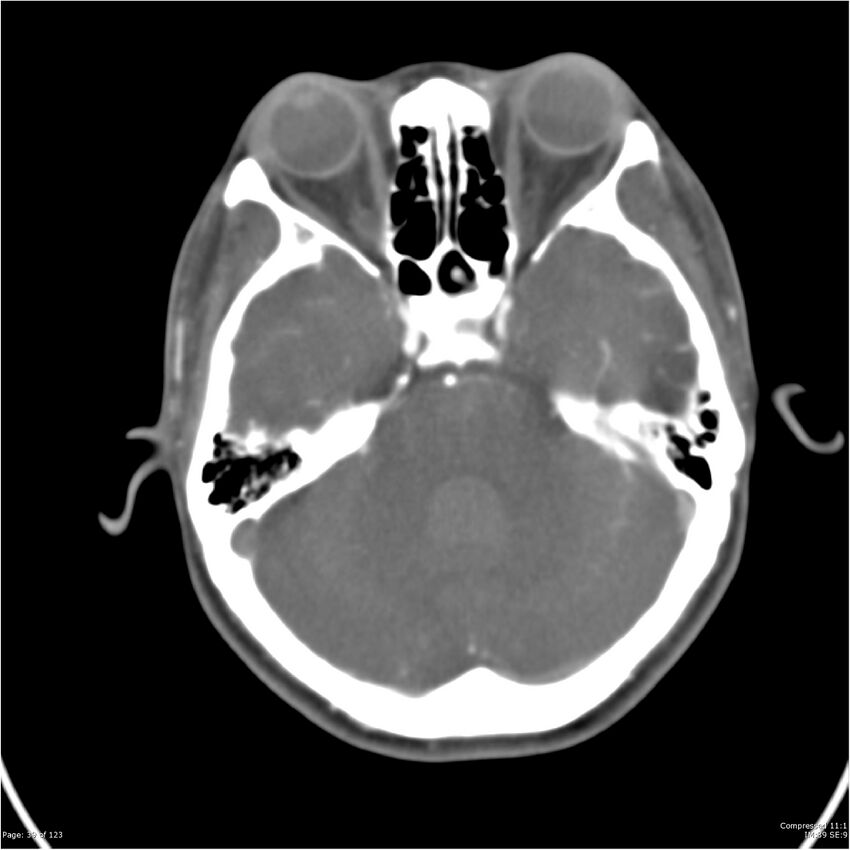 Aneurysmal subarachnoid hemorrhage and Moya Moya disease (Radiopaedia 34306-35593 Axial CT COW 39).jpg