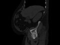 Ankylosing spondylitis (Radiopaedia 44609-48357 Sagittal bone window 20).jpg