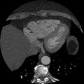 Anomalous origin of left circumflex artery from right coronary sinus (Radiopaedia 72563-83117 B 141).jpg