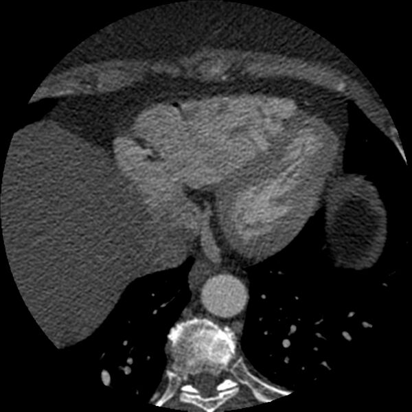 File:Anomalous origin of left circumflex artery from right coronary sinus (Radiopaedia 72563-83117 B 141).jpg