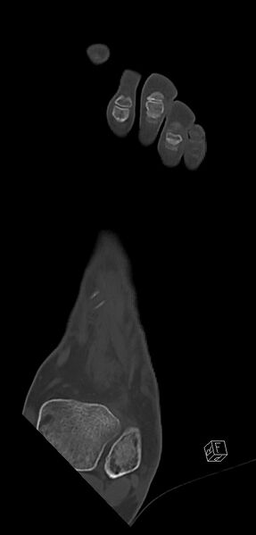 File:Anterior calcaneal process fracture (Radiopaedia 63353-71943 Coronal bone window 12).jpg