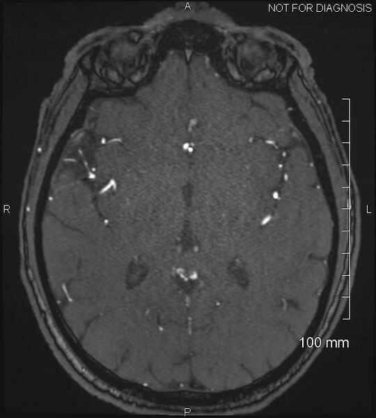 File:Anterior cerebral artery aneurysm (Radiopaedia 80683-94127 Axial MRA 126).jpg