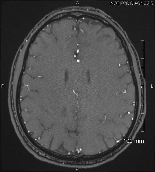 File:Anterior cerebral artery aneurysm (Radiopaedia 80683-94127 Axial MRA 170).jpg