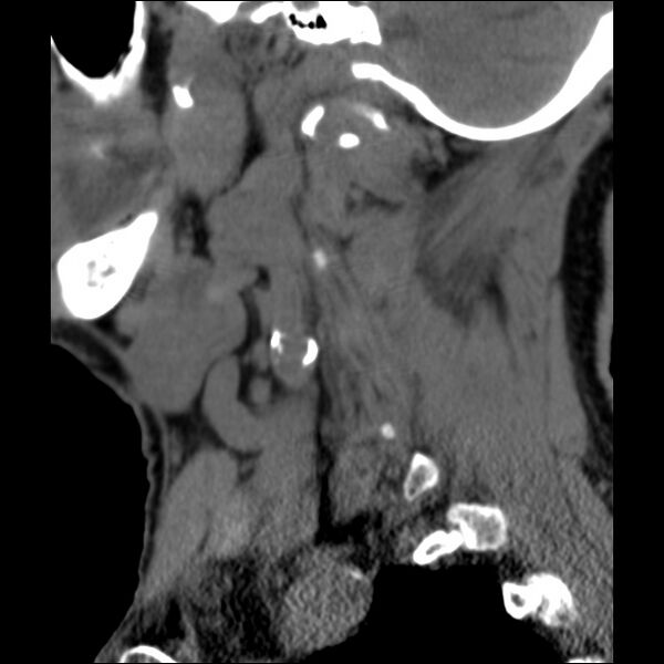 File:Anterior cervical postdiscectomy arthrodesis (Radiopaedia 32678-33646 C 5).jpg