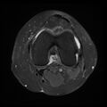 Anterior cruciate ligament tear, Wrisberg rip and bucket-handle tear of medial meniscus (Radiopaedia 75872-87266 Axial PD fat sat 14).jpg