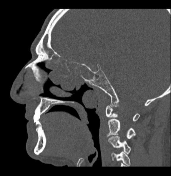 File:Antrochoanal polyp (Radiopaedia 79011-92169 Sagittal bone window 37).jpg