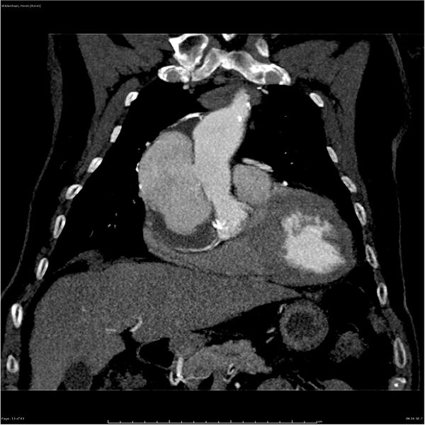 File:Aortic dissection - Stanford type A (Radiopaedia 26183-26315 A 13).jpg
