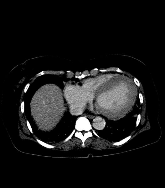 File:Aortic dissection with renal ischemia (Radiopaedia 76573-88338 B 19).jpg