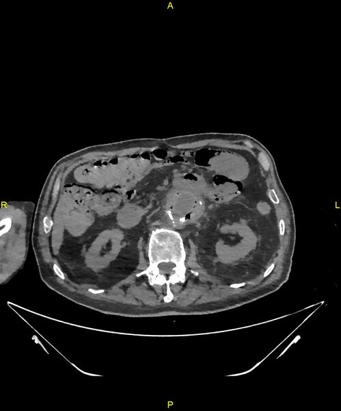 File:Aortoenteric fistula (Radiopaedia 84308-99603 Axial non-contrast 134).jpg