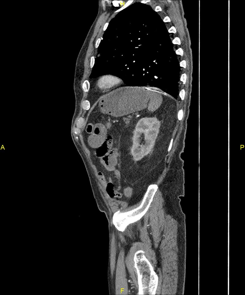 Aortoenteric fistula (Radiopaedia 84308-99603 C 271).jpg
