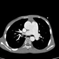 Aortopulmonary window, interrupted aortic arch and large PDA giving the descending aorta (Radiopaedia 35573-37074 B 37).jpg