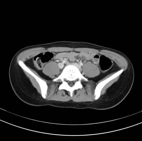 File:Appendicitis and incidental bicornuate uterus (Radiopaedia 22833-22853 B 30).jpg