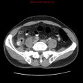 Appendicitis and renal cell carcinoma (Radiopaedia 17063-16760 A 40).jpg