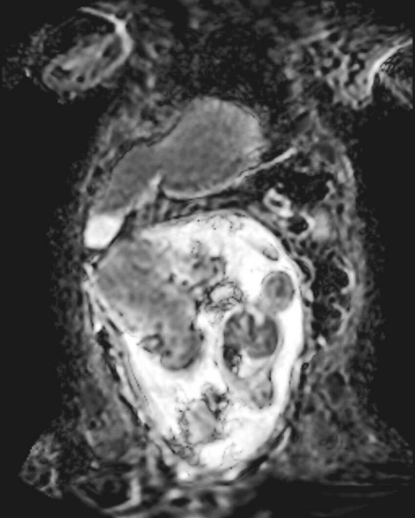 Appendicitis in gravida (MRI) (Radiopaedia 89433-106395 Coronal ADC 17).jpg