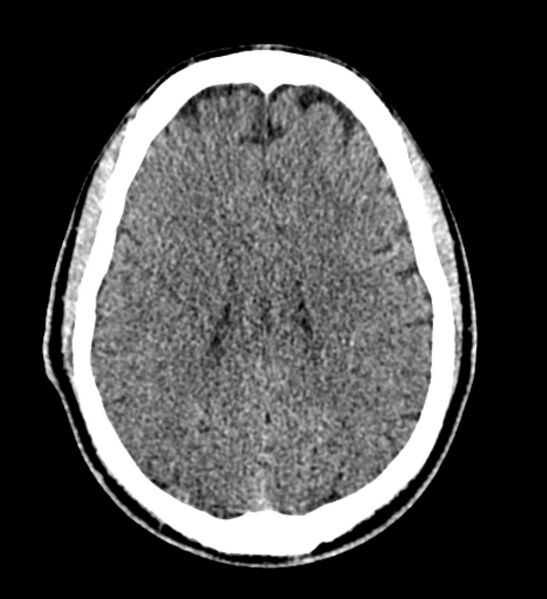 File:Arachnoid cyst of the ambient cistern (Radiopaedia 81301-94986 Axial non-contrast 45).jpg
