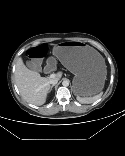 File:Arterial occlusive mesenteric ischemia (Radiopaedia 84641-100054 A 29).jpg