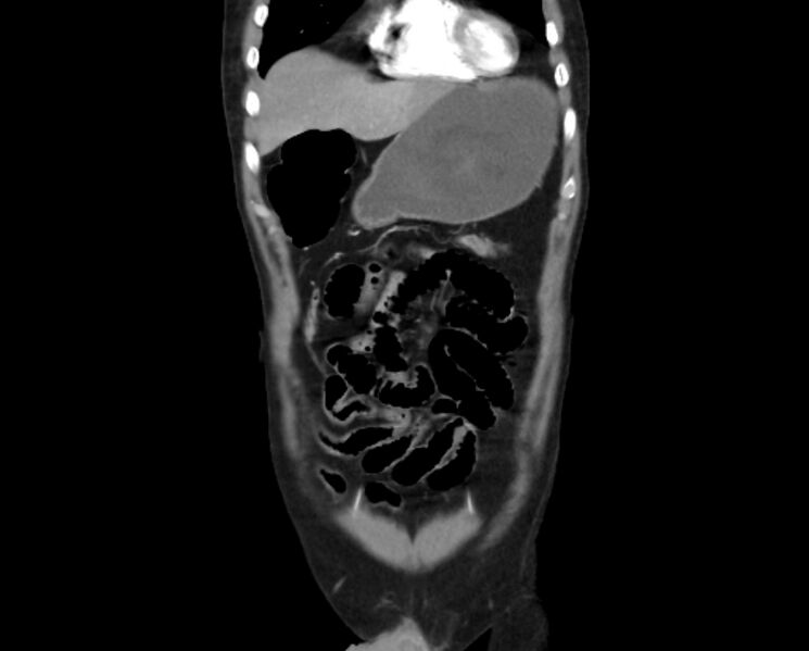 File:Arterial occlusive mesenteric ischemia (Radiopaedia 84641-100060 B 11).jpg