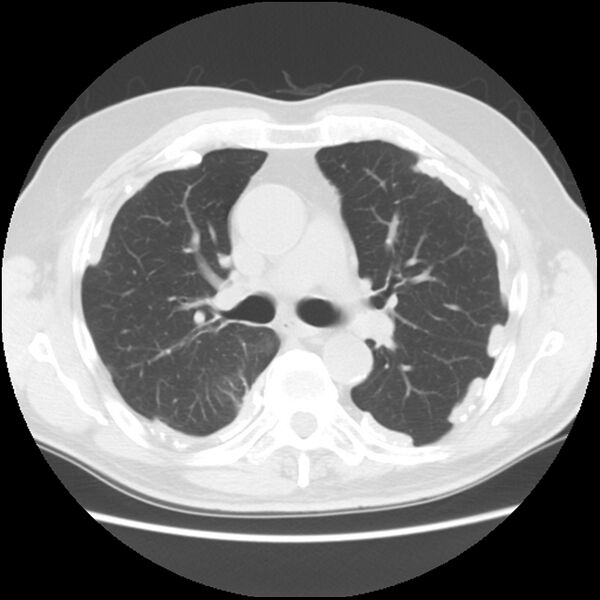 File:Asbestos-related pleural plaques (Radiopaedia 39069-41255 Axial lung window 31).jpg