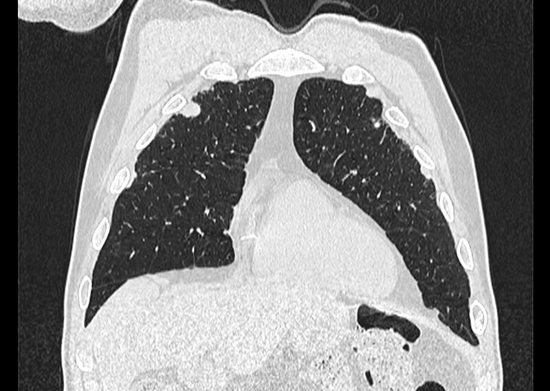 File:Asbestos pleural placques (Radiopaedia 57905-64872 Coronal lung window 58).jpg