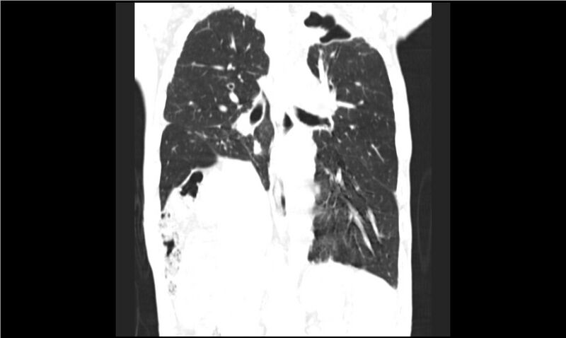 File:Aspergilloma (Radiopaedia 20788-20701 Coronal lung window 10).jpg