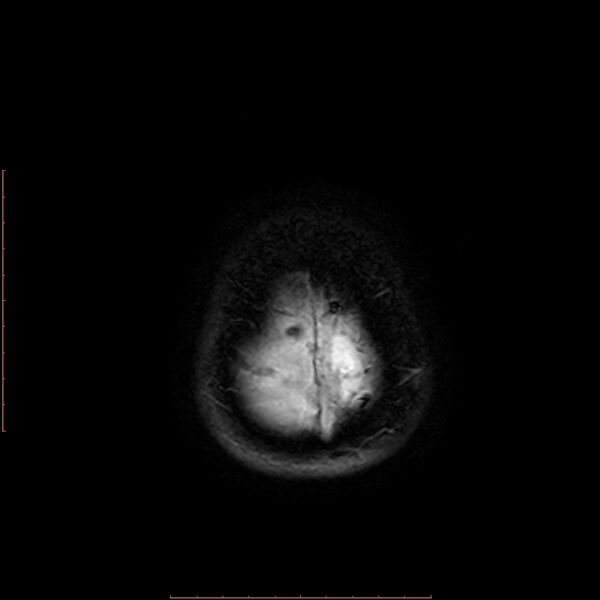 File:Astroblastoma (Radiopaedia 74287-85162 Axial SWI 22).jpg