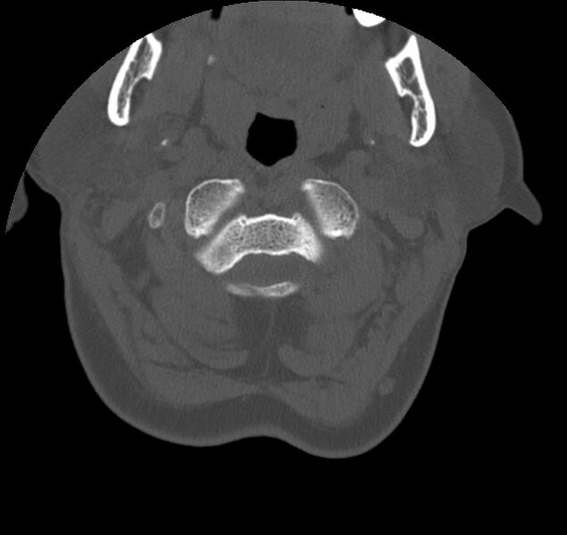 File:Atlanto-occipital assimilation with basilar invagination (Radiopaedia 70122-80188 Axial bone window 28).jpg