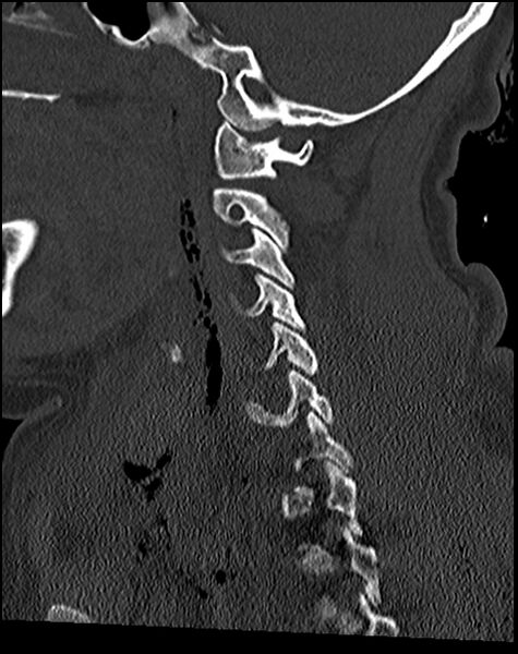 File:Atlanto-occipital dissociation - Traynelis type 1 (Radiopaedia 87570-103948 Sagittal bone window 37).jpg