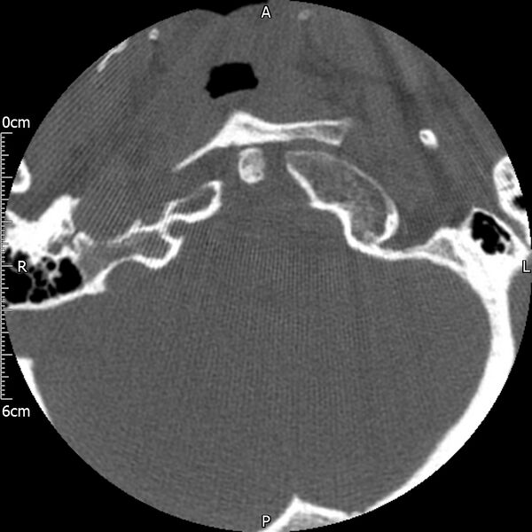 File:Atlas fracture with Currarino type A congenital defect (Radiopaedia 71747-82144 Axial bone window 13).jpg