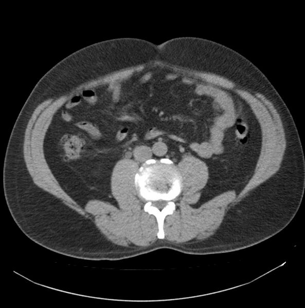 File:Atrophic kidney due to severe chronic obstructive hydronephrosis (Radiopaedia 40828-43474 Axial non-contrast 16).jpg