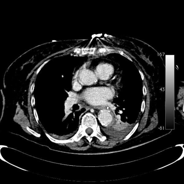 File:Atypical dissection of the thoracic aorta (Radiopaedia 10975-78320 A 36).jpg
