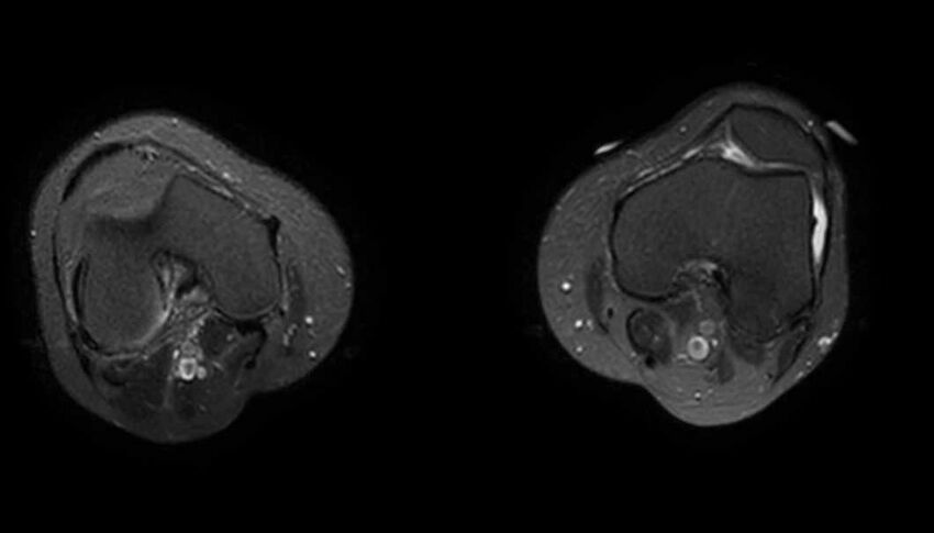 Atypical lipomatous tumor - thigh (Radiopaedia 68975-78734 Axial T2 fat sat 9).jpg