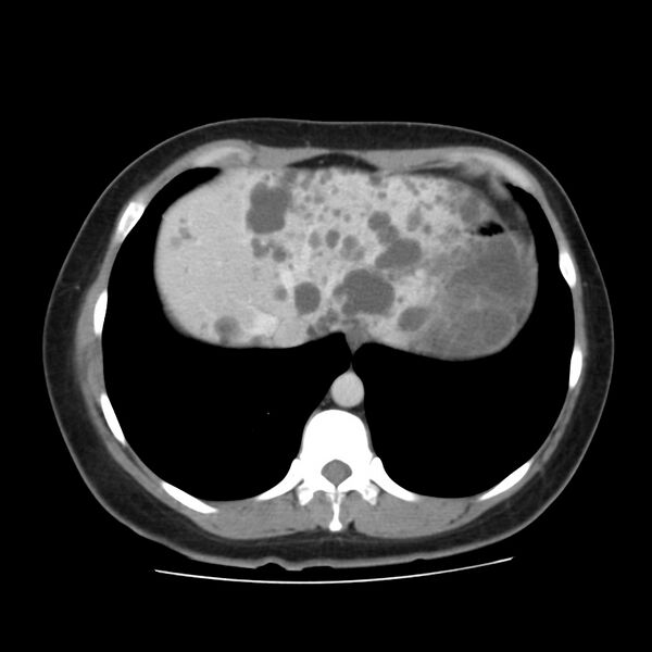 File:Autosomal dominant polycystic kidney disease (Radiopaedia 23061-23093 C 8).jpg