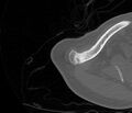Avulsion fracture - greater tuberosity of humerus (Radiopaedia 71216-81514 Axial bone window 4).jpg