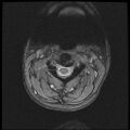 Axis fracture - MRI (Radiopaedia 71925-82375 Axial T2 fat sat 5).jpg